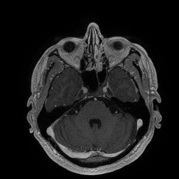 File:Acoustic schwannoma - intracanalicular (Radiopaedia 37247-39024 Axial T1 C+ 75).jpg
