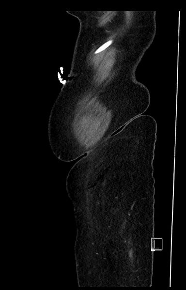 File:Active Crohn disease (Radiopaedia 59394-66750 Sagittal C+ portal venous phase 55).jpg