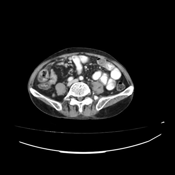 File:Acute-on-chronic Crohn disease with enteroenteric fistula (Radiopaedia 66686-75987 B 26).jpg