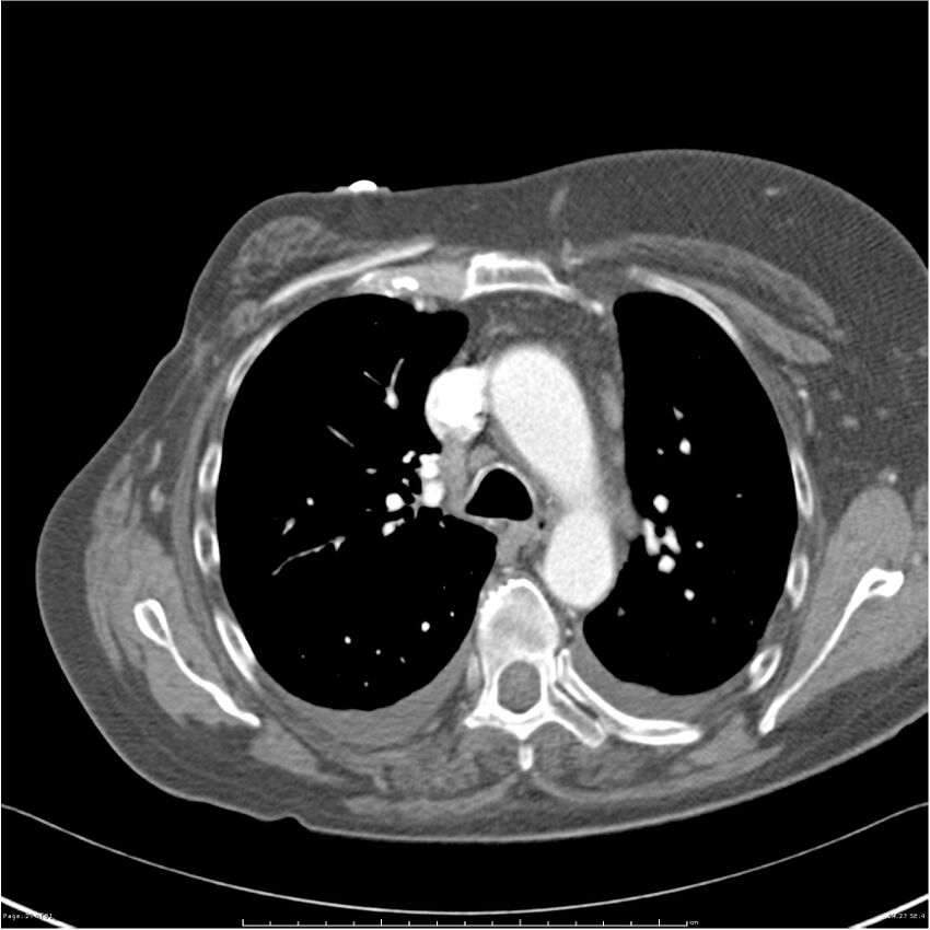 Acute-on-chronic pulmonary emboli (Radiopaedia 27925-28169 C+ CTPA 27).jpg