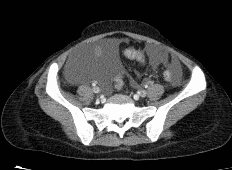 File:Acute Budd-Chiari syndrome (Radiopaedia 60858-68638 Axial C+ portal venous phase 224).jpg