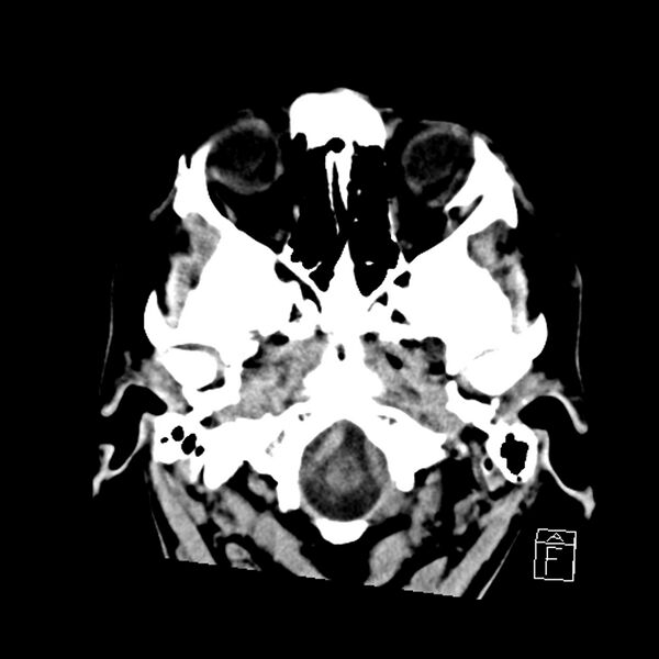 File:Acute P1 occlusion with PCA ischemia penumbra (CT perfusion) (Radiopaedia 72084-82586 Axial non-contrast 3).jpg