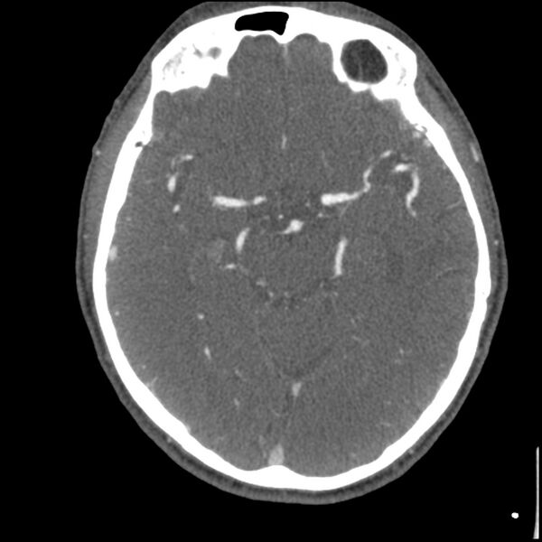 File:Acute P1 occlusion with PCA ischemia penumbra (CT perfusion) (Radiopaedia 72084-82587 Axial C+ arterial thins 34).jpg