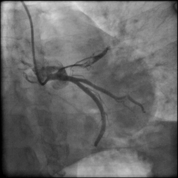 File:Acute anteroseptal myocardial infarction (Radiopaedia 68409-77946 LAO caudal (spider view) LAD and CX 22).jpg