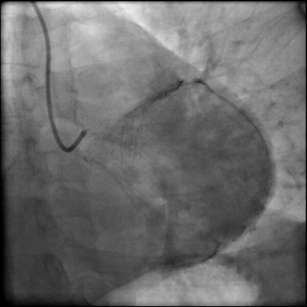 File:Acute anteroseptal myocardial infarction (Radiopaedia 68409-77946 LAO caudal (spider view) LAD and CX 65).jpg