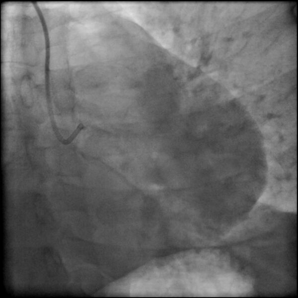 File:Acute anteroseptal myocardial infarction (Radiopaedia 68409-77946 LAO caudal (spider view) LAD and CX 8).jpg