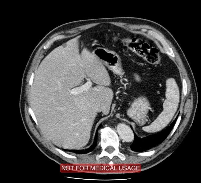 File:Acute aortic dissection - Stanford type A (Radiopaedia 40661-43285 Axial C+ portal venous phase 65).jpg