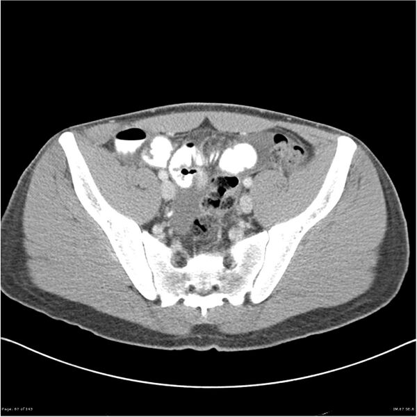 File:Acute appendicitis (Radiopaedia 25364-25615 B 57).jpg
