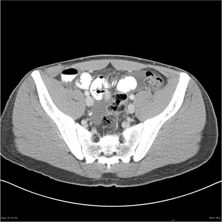 Acute appendicitis (Radiopaedia 25364-25615 B 57).jpg
