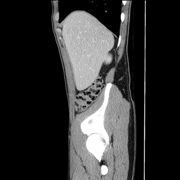File:Acute appendicitis (Radiopaedia 27049-27227 Sagittal C+ portal venous phase 14).jpg