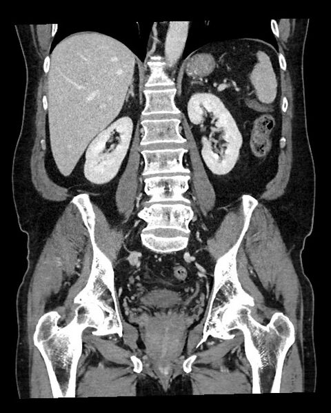 File:Acute appendicitis - large appendicoliths (Radiopaedia 61805-69820 Coronal C+ portal venous phase 86).jpg