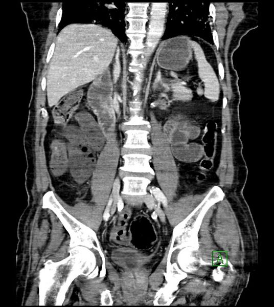 File:Acute arterial mesenteric ischemia (Radiopaedia 78238-90828 Coronal C+ portal venous phase 57).jpg