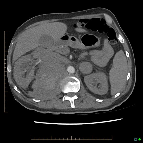 File:Acute hemorrhage into adrenal metastasis from NSCLC (Radiopaedia 43135-46429 Axial C+ CTPA 17).jpg