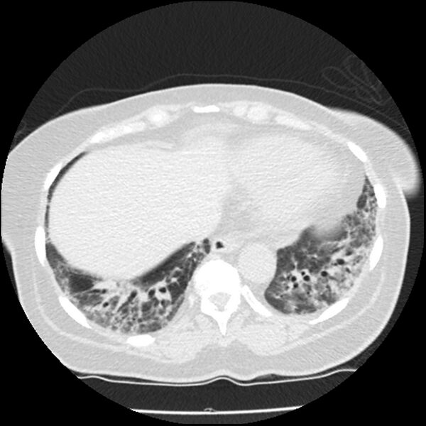 File:Acute interstitial pneumonitis (Radiopaedia 45404-49444 Axial lung window 79).jpg