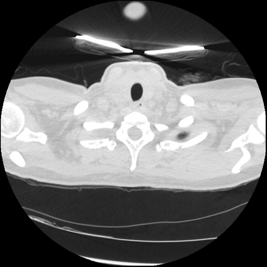Acute lupus nephritis (Radiopaedia 45832-50107 Axial lung window 3).jpg