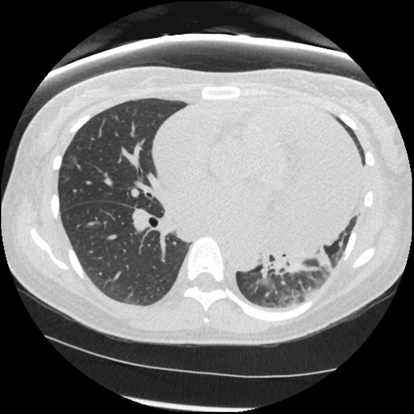 Acute lupus nephritis (Radiopaedia 45832-50107 Axial lung window 51).jpg