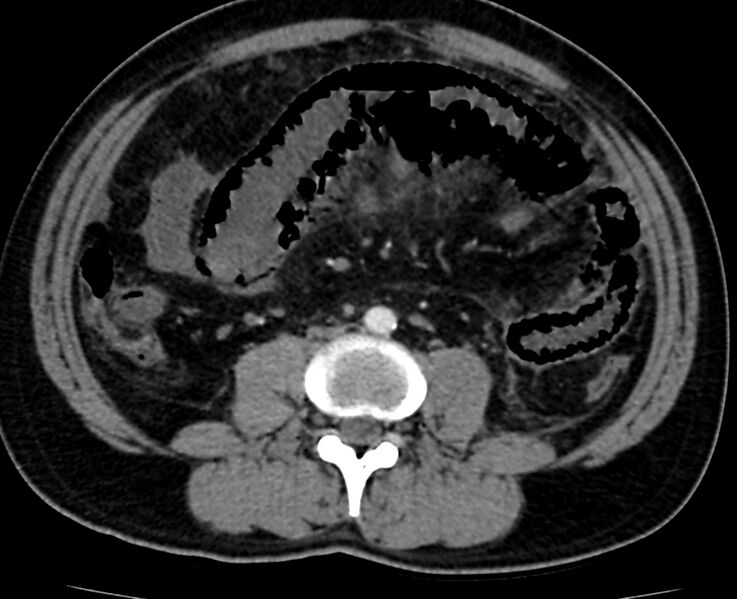 File:Acute mesenteric ischemia - superior mesenteric artery thrombosis (Radiopaedia 73947-84776 Axial C+ arterial phase 80).jpg