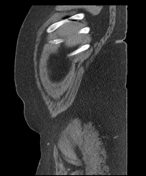 File:Acute mesenteric venous ischemia (Radiopaedia 46041-50383 Sagittal C+ portal venous phase 9).jpg