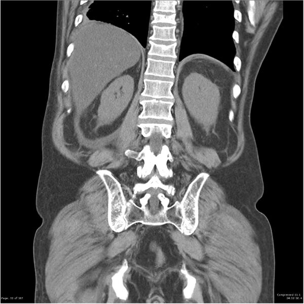 File:Acute pancreatitis (Radiopaedia 19135-19116 Coronal non-contrast 37).jpg