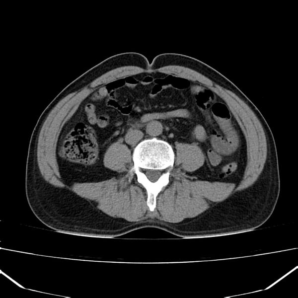 File:Acute pancreatitis (Radiopaedia 22572-22596 Axial non-contrast 38).jpg