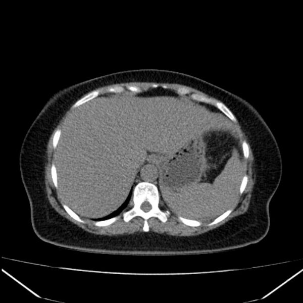 File:Acute pancreatitis - Balthazar C (Radiopaedia 26569-26714 Axial non-contrast 21).jpg