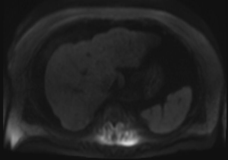 File:Acute portal vein thrombosis (Radiopaedia 73198-83925 Axial DWI 71).jpg