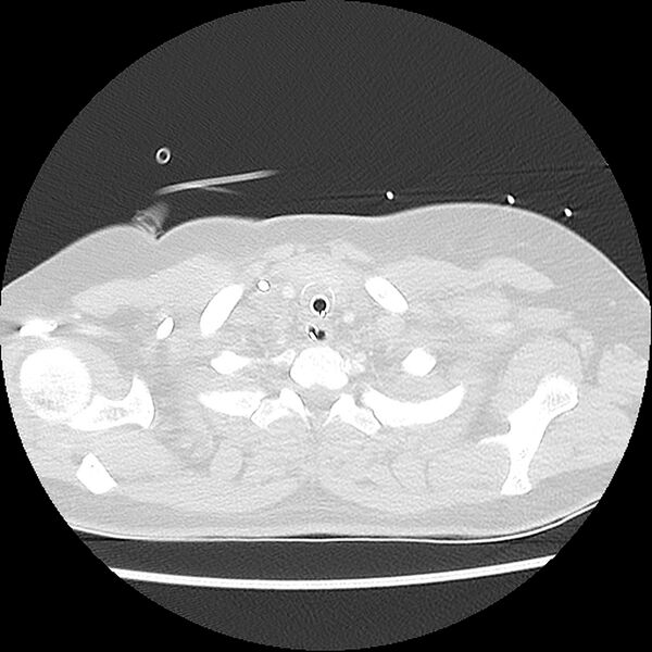 File:Acute pulmonary edema on CT (Radiopaedia 33582-34672 Axial lung window 1).jpg