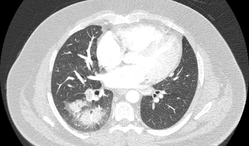 Acute pulmonary embolism with pulmonary infarcts (Radiopaedia 77688-89908 Axial lung window 70).jpg