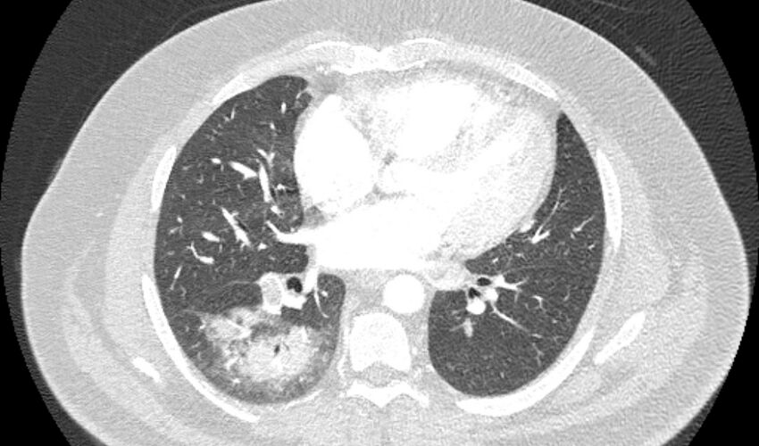 Acute pulmonary embolism with pulmonary infarcts (Radiopaedia 77688-89908 Axial lung window 71).jpg