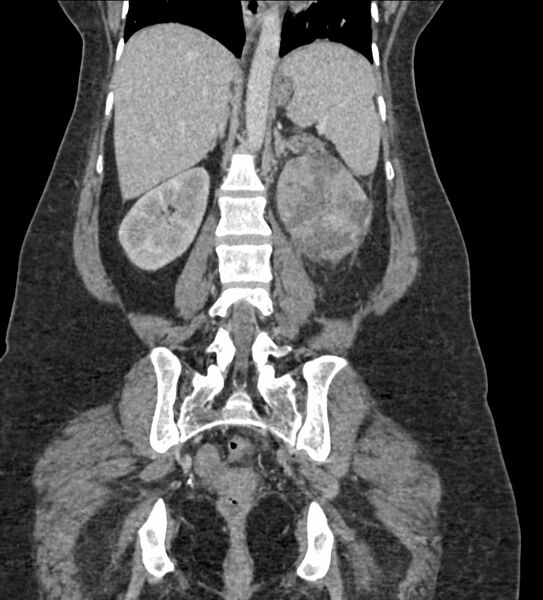 File:Acute pyelonephritis with renal vein thrombosis (Radiopaedia 58020-65053 Coronal renal parenchymal phase 76).jpg