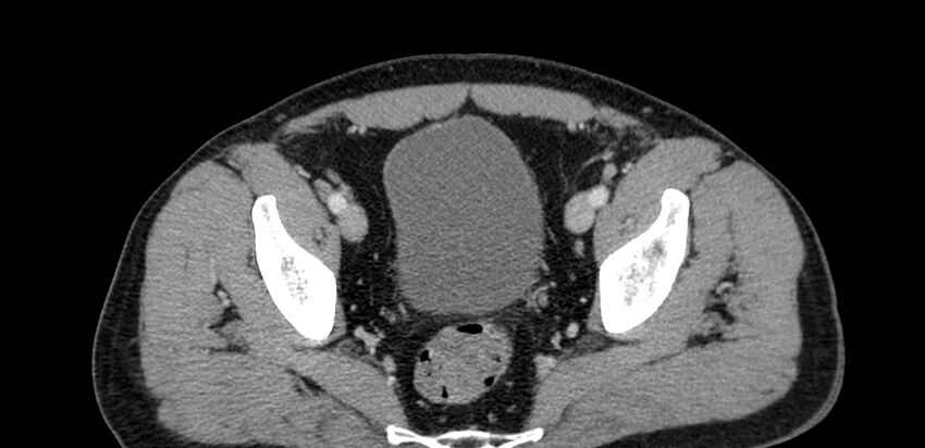 Acute sigmoid colon diverticulitis (Radiopaedia 55507-61976 Axial C+ portal venous phase 101).jpg