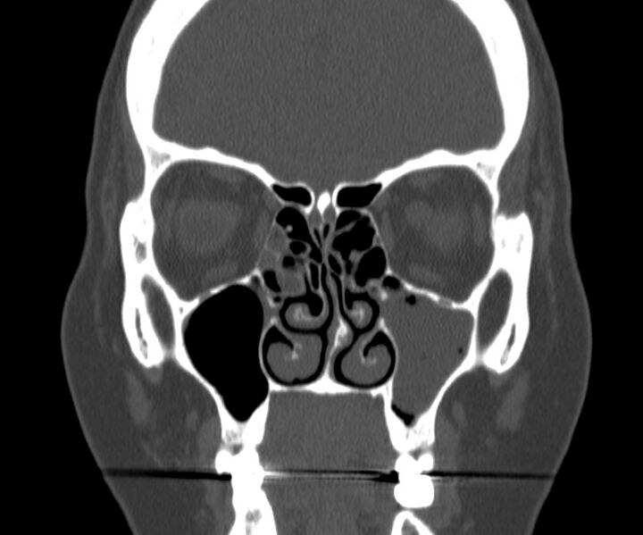 File:Acute sinusitis (Radiopaedia 22419-22455 Coronal bone window 16).jpg