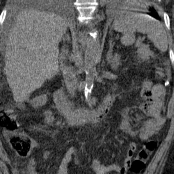 File:Acute tubular necrosis (Radiopaedia 28077-28334 Coronal non-contrast 1).jpg