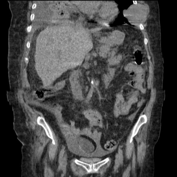 File:Acute tubular necrosis (Radiopaedia 28077-28334 G 42).jpg