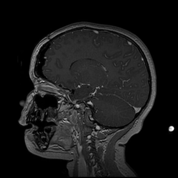 File:Adamantinomatous craniopharyngioma (Radiopaedia 77407-89529 H 48).jpg