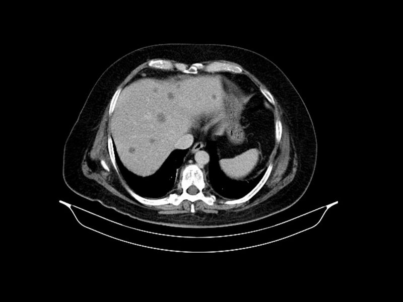 File:Adenocarcinoma of pancreas with hepatic metastasis (Radiopaedia 64332-73122 Axial C+ delayed 17).jpg