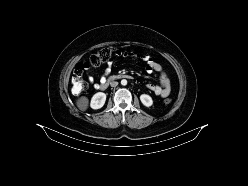 File:Adenocarcinoma of pancreas with hepatic metastasis (Radiopaedia 64332-73122 Axial C+ portal venous phase 49).jpg