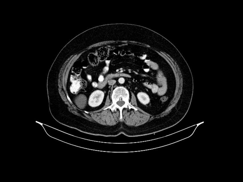 Adenocarcinoma of pancreas with hepatic metastasis (Radiopaedia 64332-73122 Axial C+ portal venous phase 49).jpg