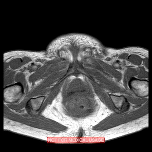 File:Adenocarcinoma of the cervix (Radiopaedia 28373-28615 Axial T1 2).jpg