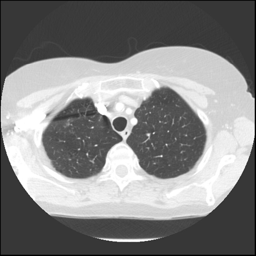 Adenocarcinoma of the lung (Radiopaedia 41015-43755 Axial lung window 22).jpg
