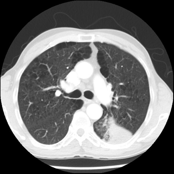 File:Adenocarcinoma of the lung - micropapillary predominant (Radiopaedia 42446-45563 Axial lung window 29).jpg
