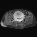 Adenomyoma of the uterus (huge) (Radiopaedia 9870-10438 Axial T1 C+ fat sat 19).jpg