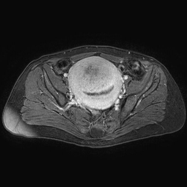 File:Adenomyoma of the uterus (huge) (Radiopaedia 9870-10438 Axial T1 C+ fat sat 19).jpg