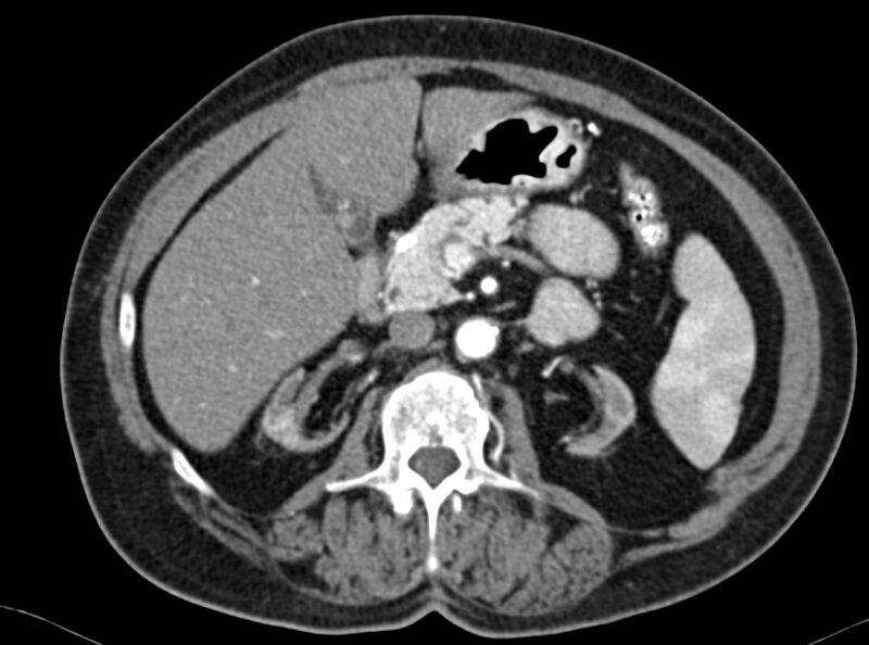 File:Adenomyomatosis of the gallbladder (Radiopaedia 12142-12483 Axial C+ arterial phase 10).jpg