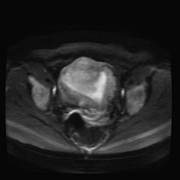 File:Adenomyosis on MRI (Radiopaedia 29328-29780 Axial DWI 8).jpg