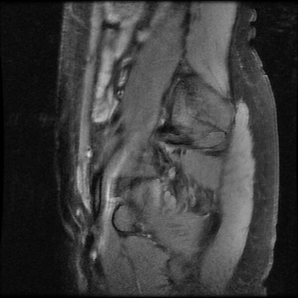 File:Adenomyosis on MRI (Radiopaedia 29328-29780 Sagittal T1 fat sat 1).jpg