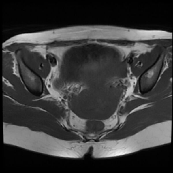 File:Adenomyosis within a septate uterus (Radiopaedia 69963-79981 Axial T1 16).jpg