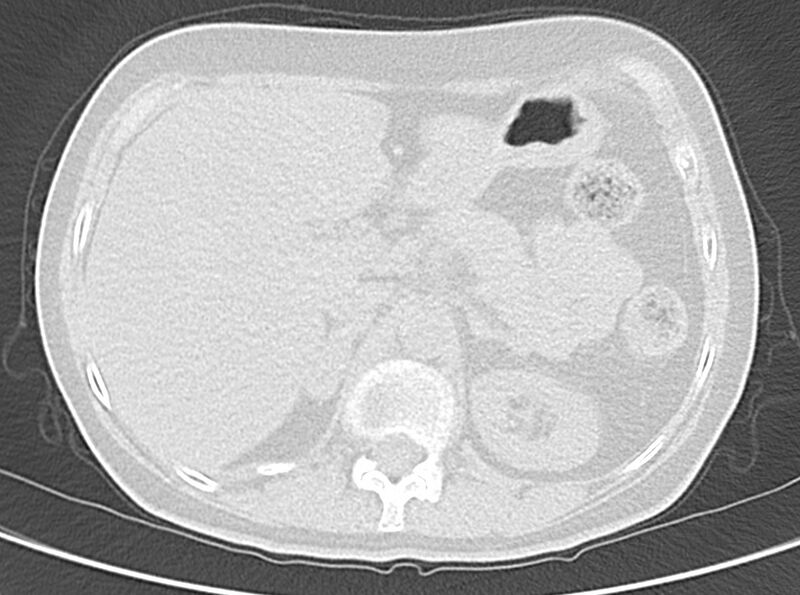File:Adenosquamous lung carcinoma (Radiopaedia 22035-22030 lung window 61).jpg
