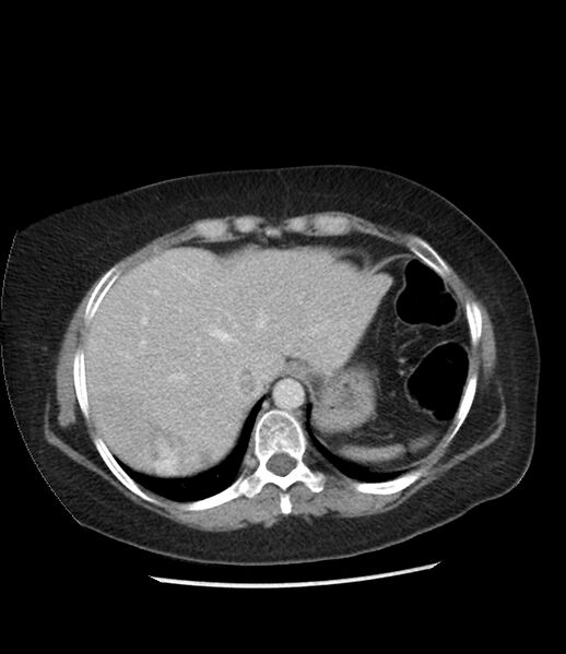 File:Adrenal cortical carcinoma with IVC invasion and thrombosis (Radiopaedia 34307-35597 Axial C+ portal venous phase 13).jpg