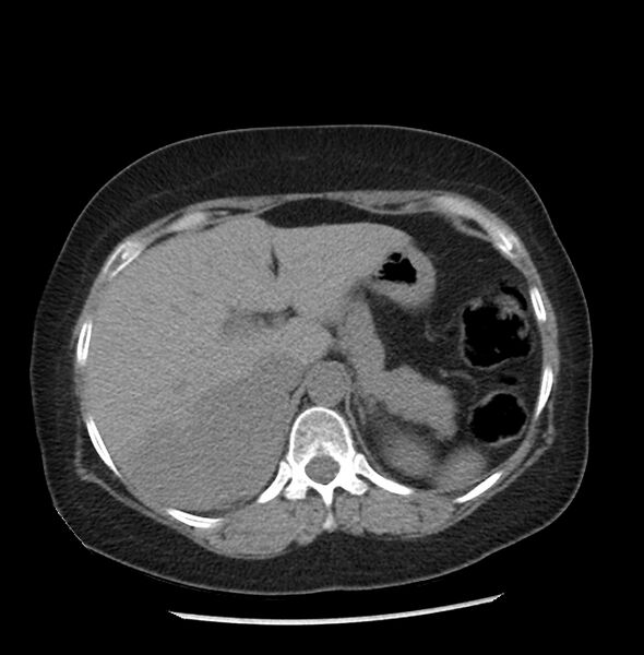 File:Adrenal cortical carcinoma with IVC invasion and thrombosis (Radiopaedia 34307-35597 Axial non-contrast 11).jpg